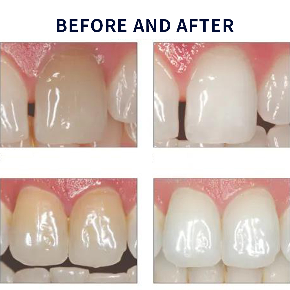 Opalwisdom-Kit de Blanchiment  - Teeth Whitening Kit At Home avis et prix
