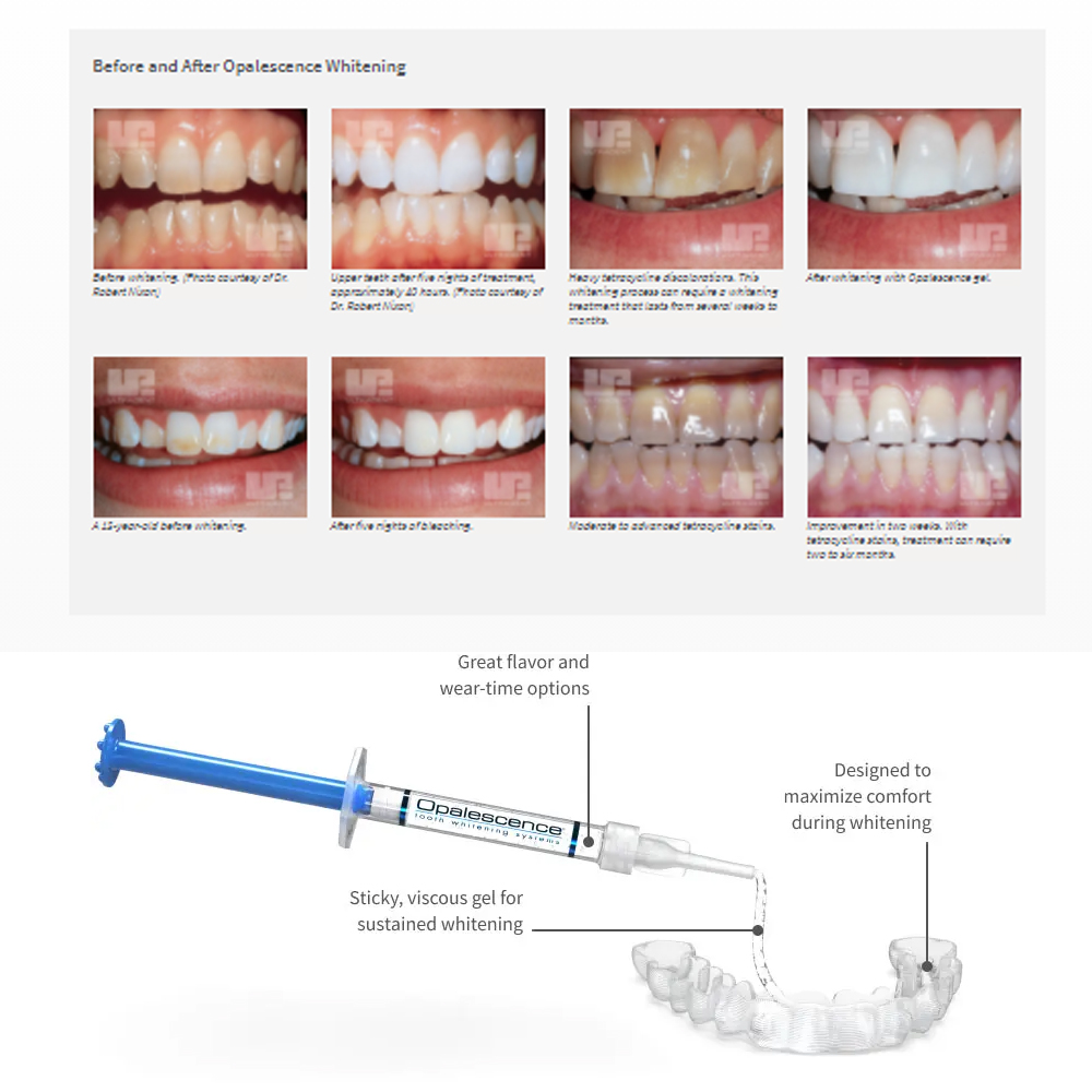 Opalwisdom-Kit de Blanchiment  - Teeth Whitening Kit At Home avis et prix