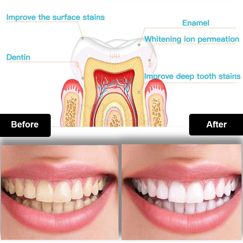Kit de blanchiment des dents d - Teeth Whitening Pen avis et prix