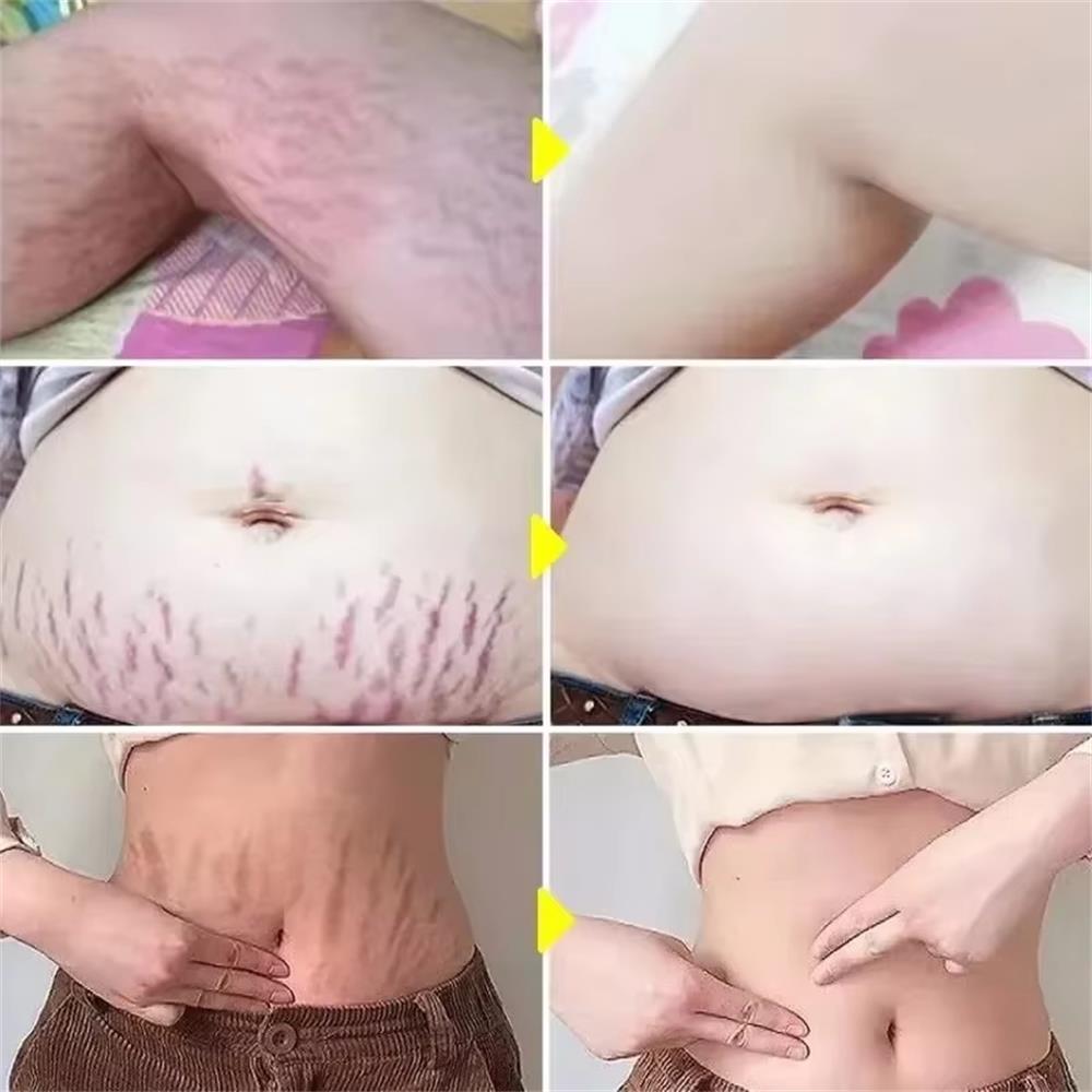 Crème anti-vergetures permanen - Teeth Whitening Pregnancy avis et prix